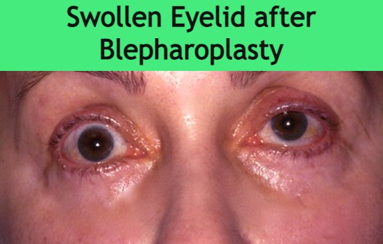 swollen-eyelid-after-blepharoplasty