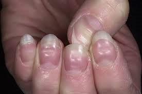 toenails diabetes yellow nails ridges horizontal nail causes