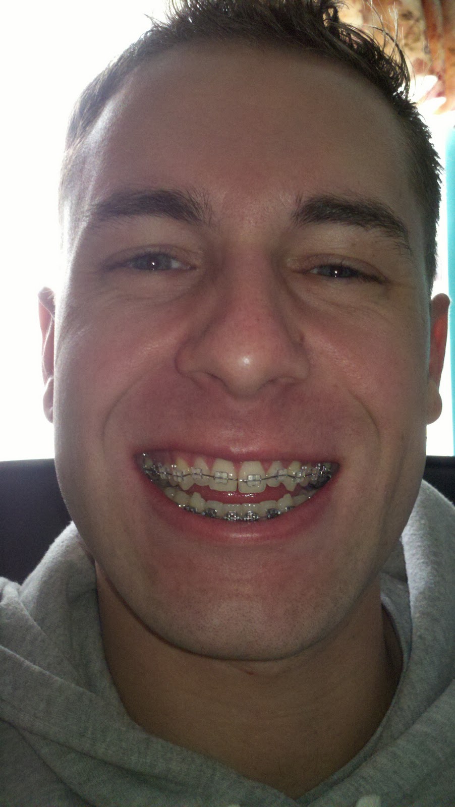 Braces/Open Bite Surgery Brace yourself!