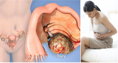 Ο καρκίνος των ωοθηκών, προκαλεί πόνο, πρήξιμο χαμηλά στην κοιλιά, αίσθημα φουσκώματος, αύξηση βάρους, κούραση Ovarian-cancer