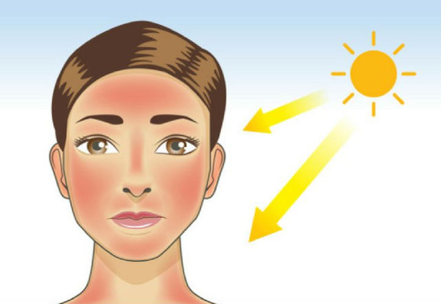 Home Remedies for Sunburn Treatment