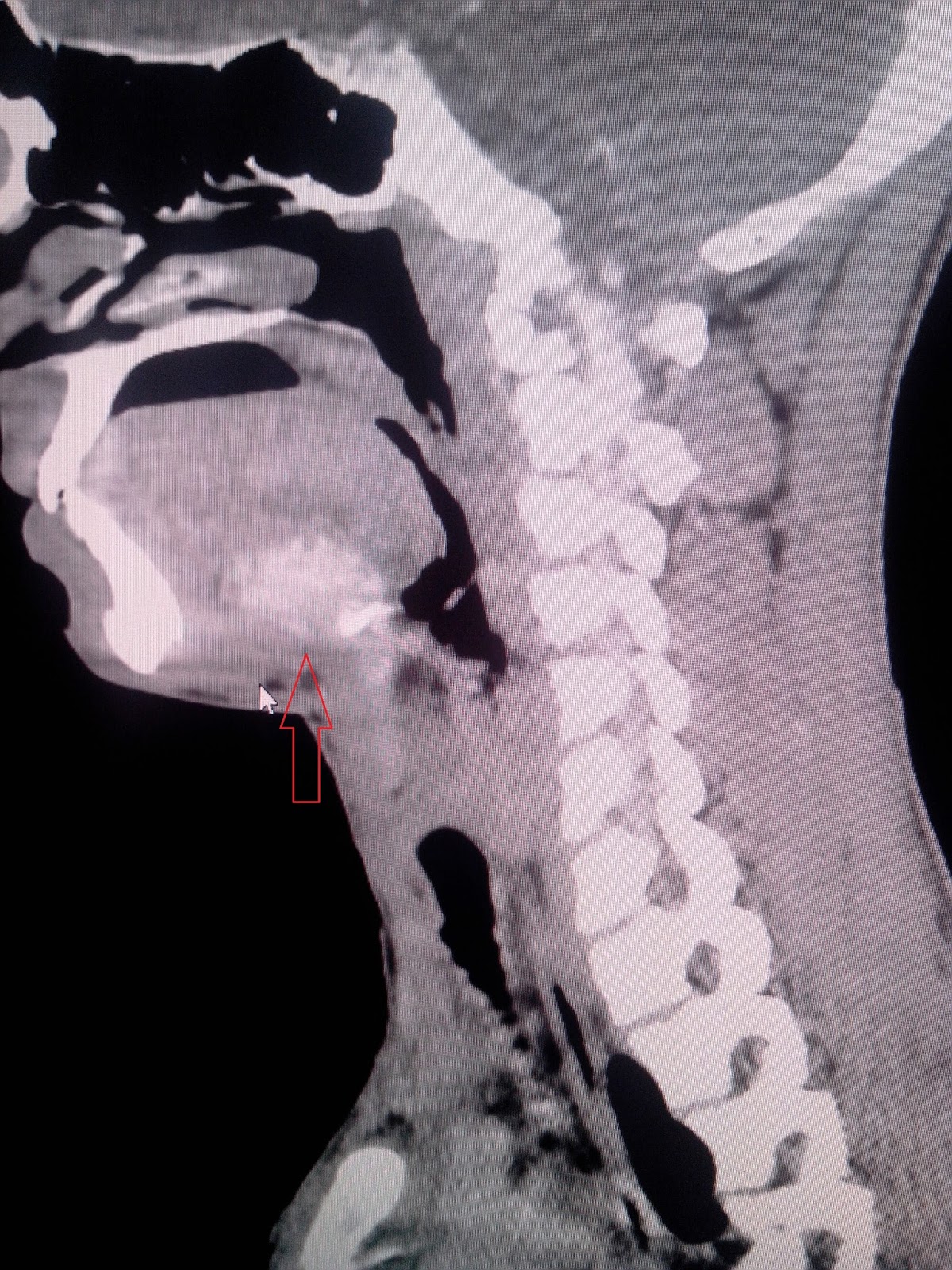 Lingual Thyroid-CT - Sumer's Radiology Blog