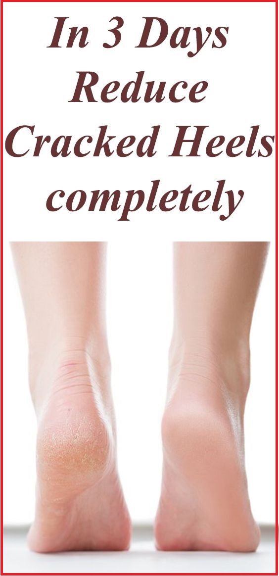 how-to-fix-cracked-heels-permanently-diy-cracked-heels-wellness