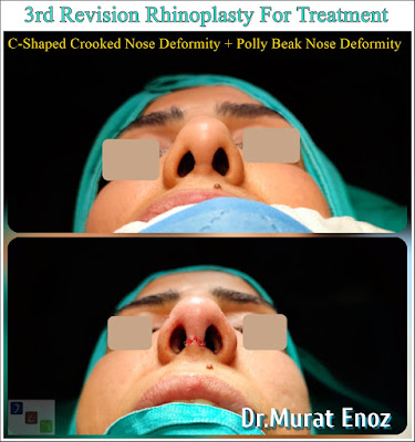 3rd Revision Rhinoplasty For Treatment of "C-Shaped Crooked Nose Deformity" + "Polly Beak Nose Deformity"  Polly Beak Deformity,Pollybeak Deformity Surgery in Istanbul,Pollybeak Deformity,parrot beak deformity,