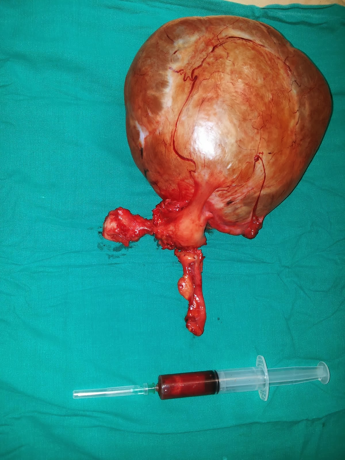 Lt.ovarian mucinous cystadenoma