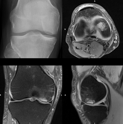 Displaced osteochondral injury of the medial femoral condyle with subsequent loose body