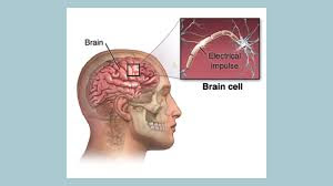 What is convulsion, signs and treatment A convulsion is an episode of neurologic dysfunction caused by abnormal neuronal activity