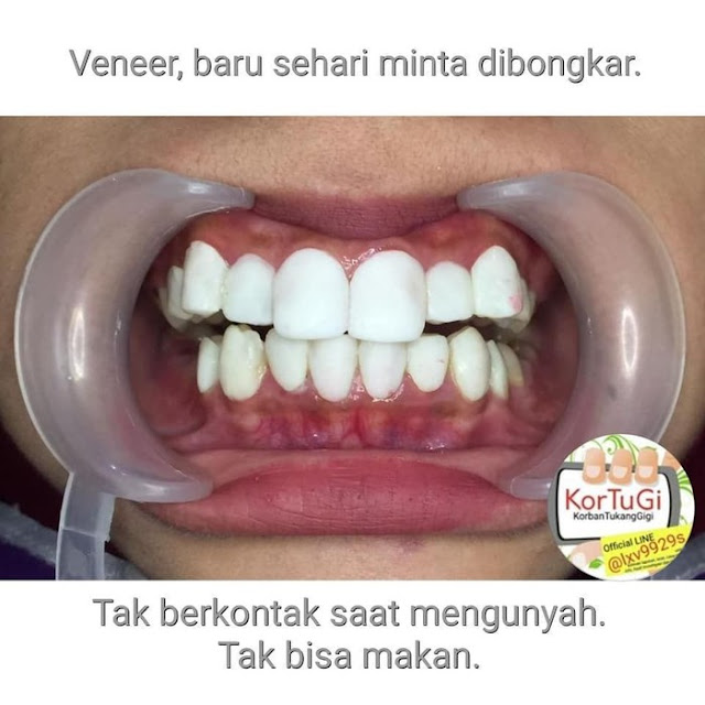 Awas!! Veneer Gigi Abal-Abal Bisa Berakibat Fatal, Bahkan Berujung Kematian Awas!! Veneer Gigi Abal-Abal Bisa Berakibat Fatal, Bahkan Berujung Kematian