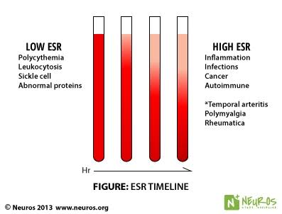 Erythrocyte Sedimentation Rate Uses Procedure Results ESR made easy ...