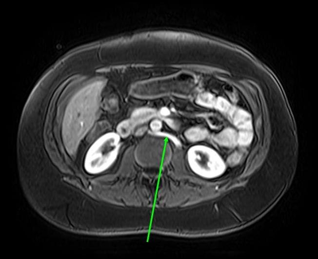 The Pump and the Tubes The Nutcracker