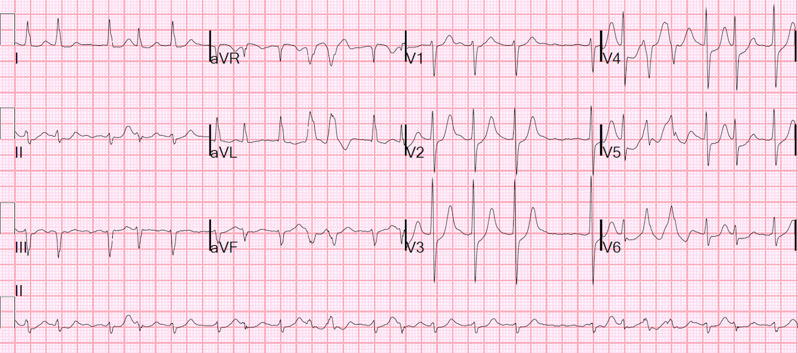 Dr. Smith's Blog: Atrial fibrillation with RVR: use to assess volume; then sinus vs. SVT: use of Lewis leads