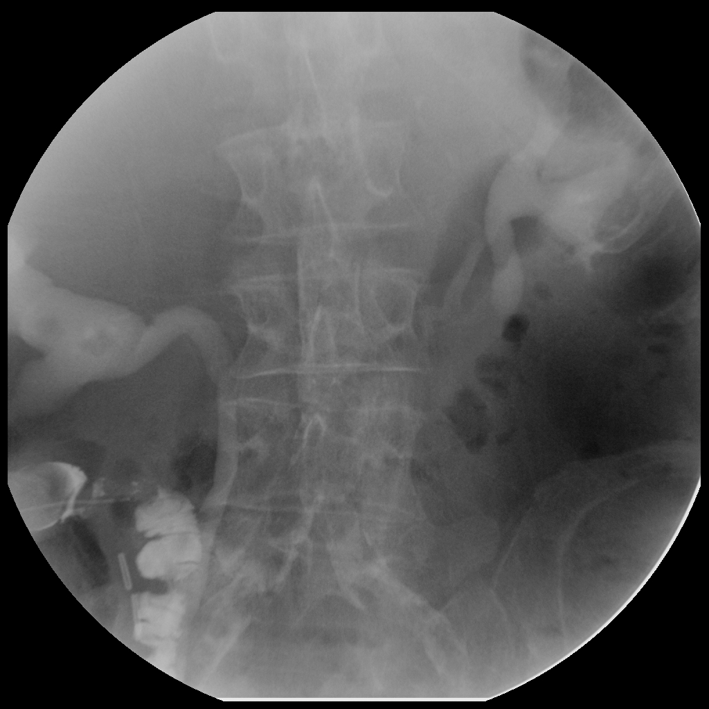 Ileal Conduit Radiology