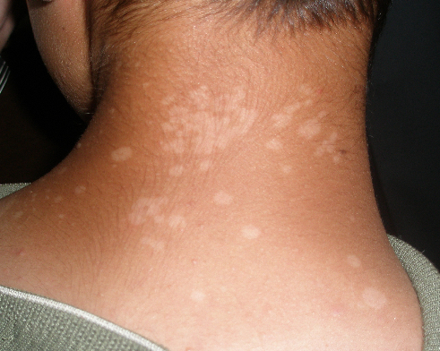 Cara Membersihkan Panu Dengan Cepat Cara Membersihkan Panu Dengan Cepat