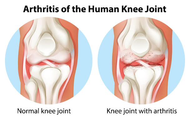 Is knee arthritis dangerous Arthritis is what disease