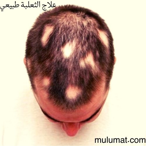 15 نوعا من العلاج الطبيعي للتخلص من الثعلبة نهائيا