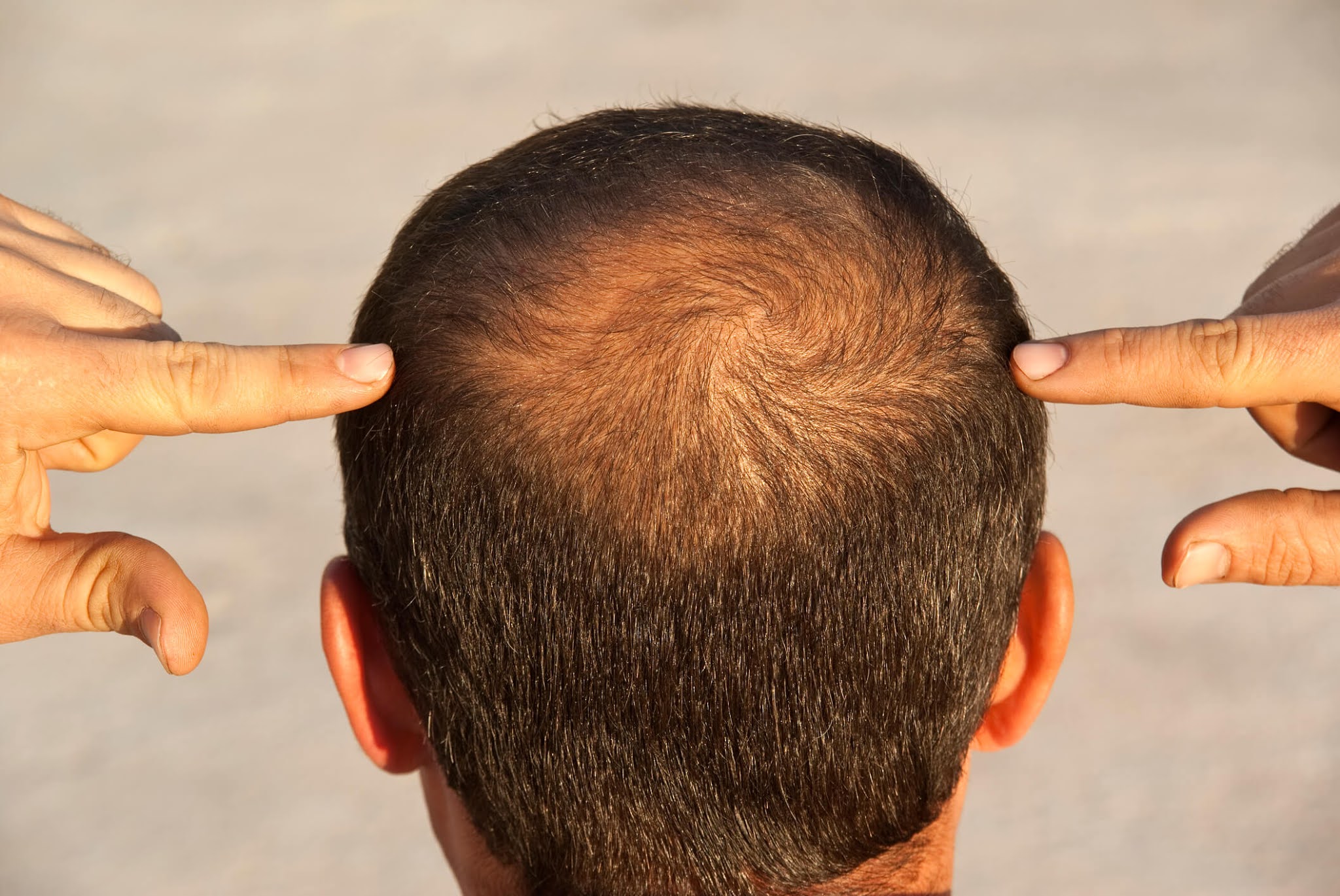 Alopecia Treatment Market Research Report 20212026 Analysis, Top Key