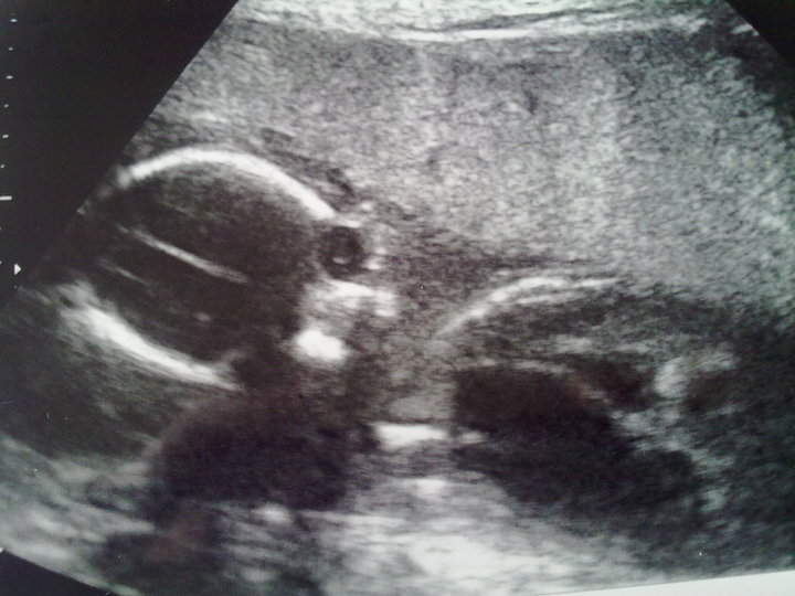 Life With Turner's Syndrome Abbigail Sharron Paige Featherstone