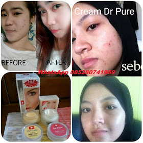 Jupiter Kosmetik Reaksi Pemakaian Cream Dr Pure Lightening Asli Bpom Jupiter Kosmetik 085280741969