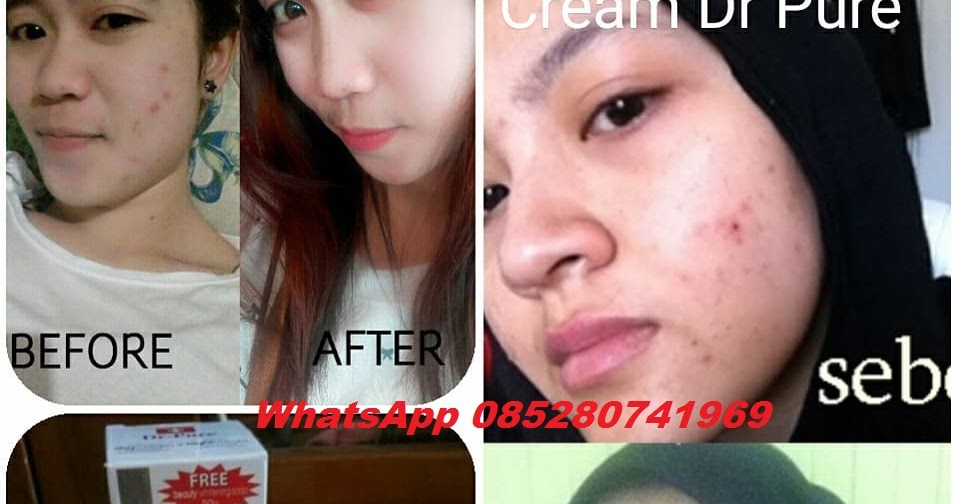 Berapa Lama Hasil Pemakaian Dr Pure