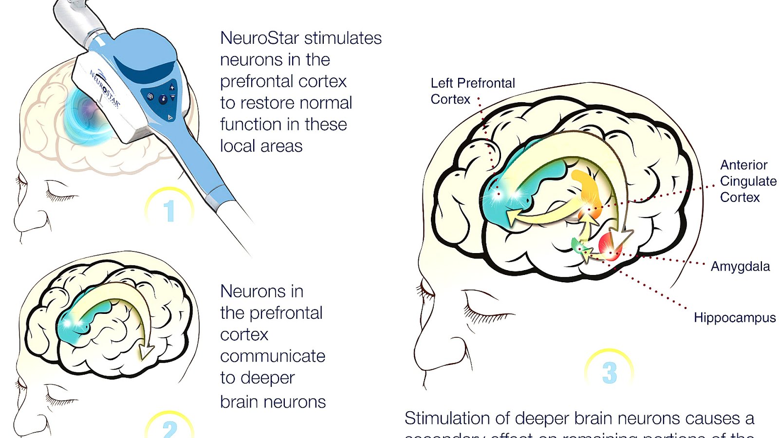 What Is Tms Therapy For Depression Depression Choices