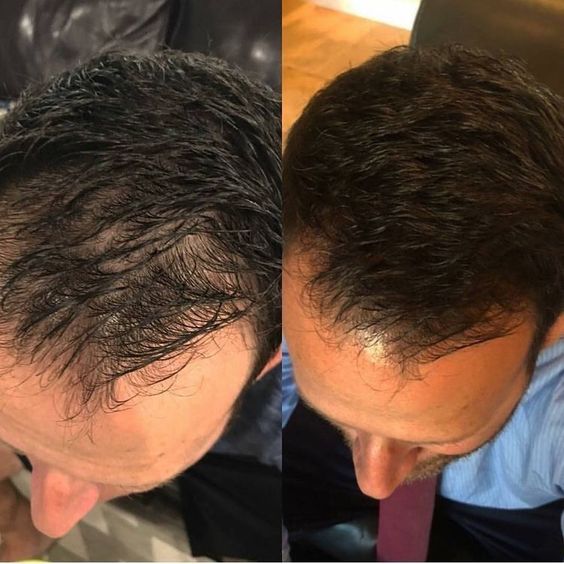 Men hair Growth Before and after Using KEEPs