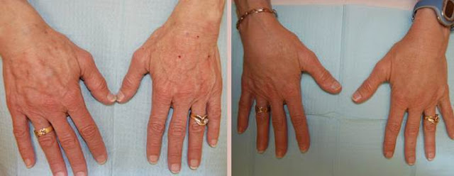 6 amazing hand rejuvenation photos