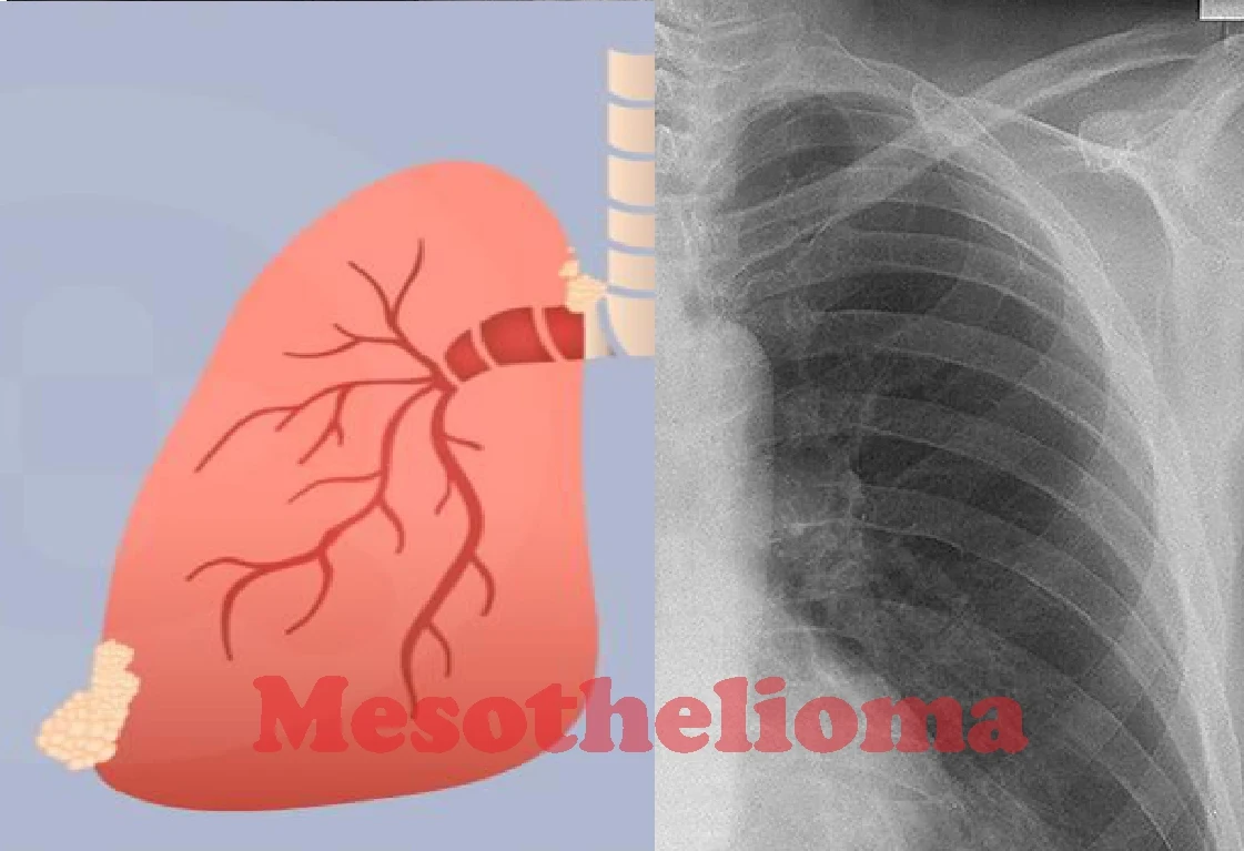 Dynamic Mesothelioma Lumps Under Skin View Concept