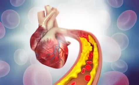 reasons for high ldl cholesterol levels reasons for high ldl cholesterol levels