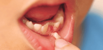  Những lưu ý khi nhổ răng sữa cho trẻ Nhorang