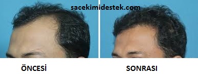 sakaklara yanlara sac ekimi sac