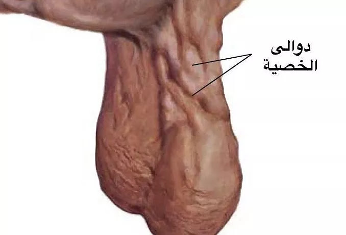 دوالي الخصية