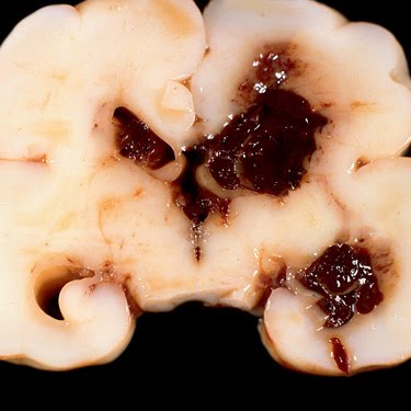 Germinal Matrix Hemorrhage - Neonatal Brain