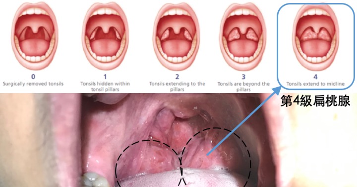 扁桃 炎 膿