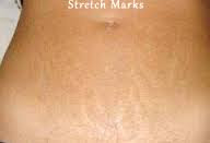Moisturizing the skin is a helpful preventive measure against stretch marks