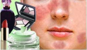 Cara Mengatasi Alergi Wajah Merah Ruam Bentol Akibat Kosmetik  Cream 