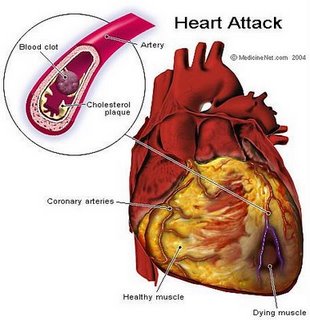 Penyakit Jantung Infark Miokard Akut