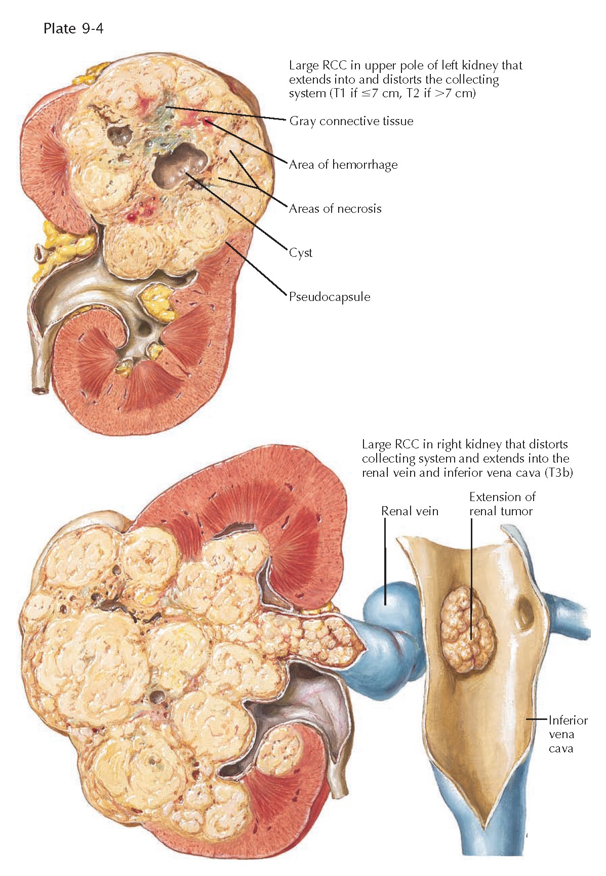 presentation of renal carcinoma
