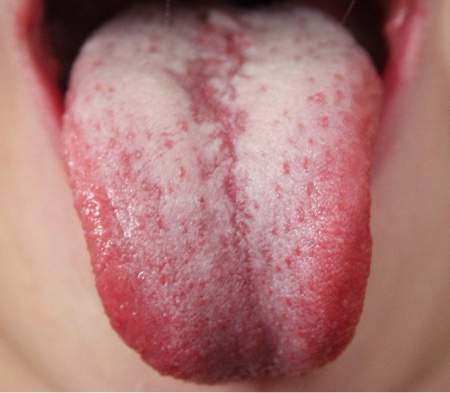 oral thrush tongue #10