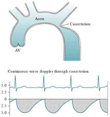 Coarctation of the aorta