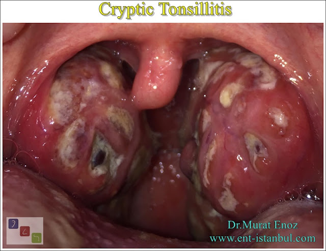 cryptic tonsillitis, severe tonsil infection