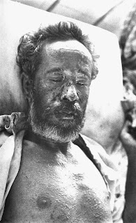 Şiddetli hemorajik tipte çiçek hastalığı olan bir adam. (Bangladeş, 1975)