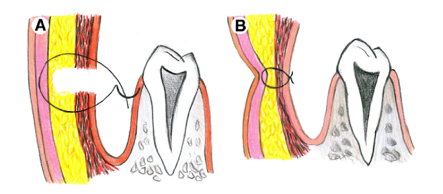 dimple surgery, Dr. shazia Ali