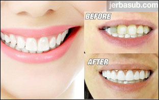 ما هو سعر ابتسامة هوليود في تركيا؟ تعرف على أسعار ابتسامة هوليود في تركيا