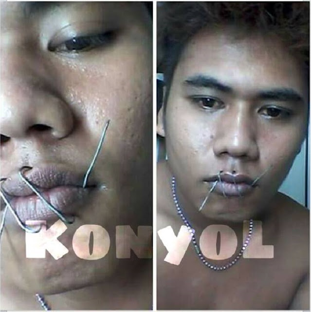 Ngeri, Gara-Gara Dianggap Bawel Ceweknya, Cowok ini Memilih Diam Hingga Menjahit Bibirnya Ngeri, Gara-Gara Dianggap Bawel Ceweknya, Cowok ini Memilih Diam Hingga Menjahit Bibirnya