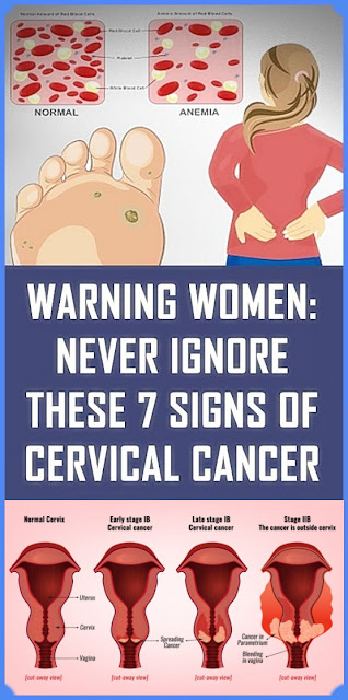 You should not ignore these 7 signs of cervical cancer