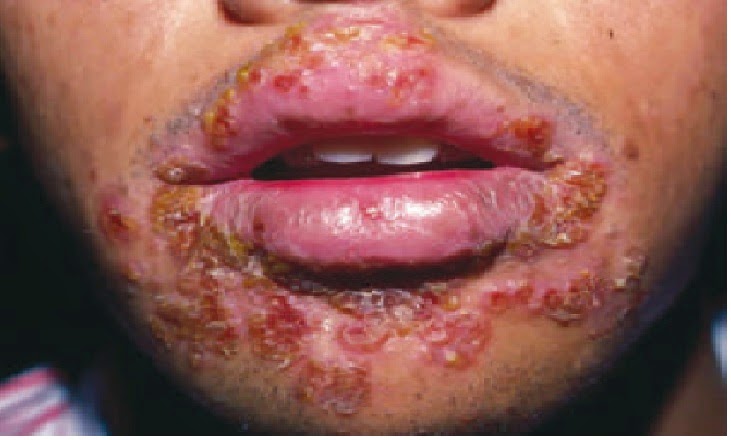 symptoms of herpes in throat #10
