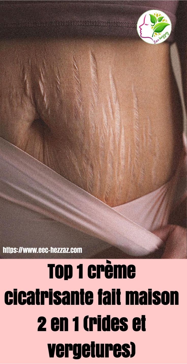 Top 1 crème cicatrisante fait maison 2 en 1 (rides et vergetures)