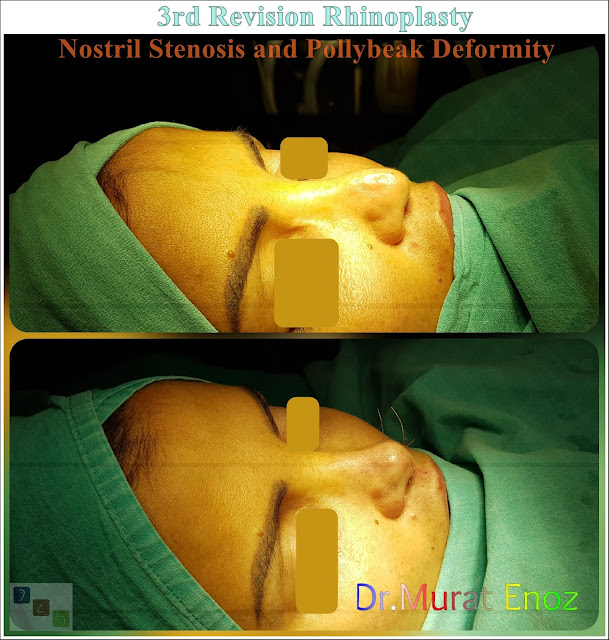 3rd Revision Rhinoplasty - Nostril Stenosis and Pollybeak Deformity