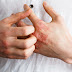 Cara Pulihkan Eczema dengan Selamat dan Berkesan