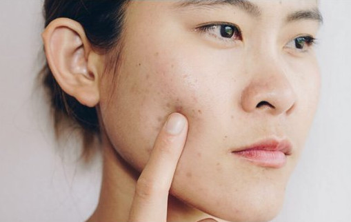 8 Cara Menghilangkan Bekas Jerawat yang Menghitam Secara Alami - INFO